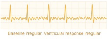 <p>What ECG trace is this?</p>