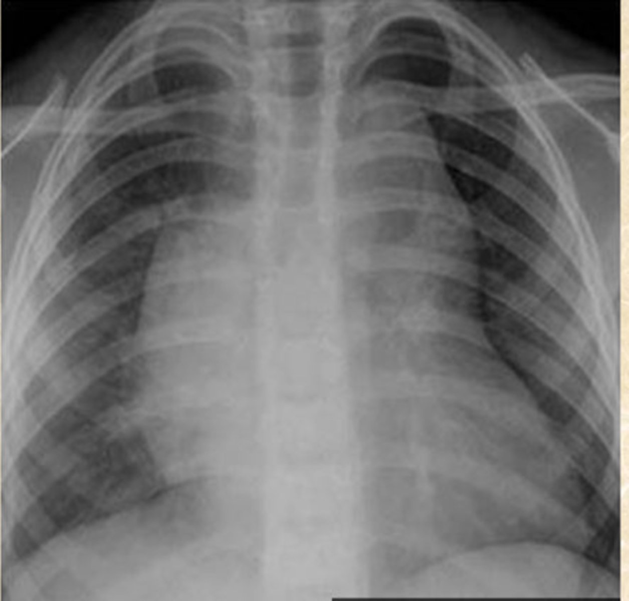 <p>What does this CXR show?</p>