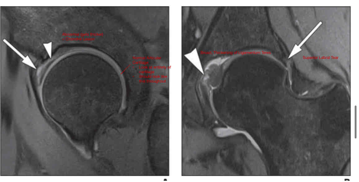 <ul><li><p>Fall into end range hip motion (trauma)</p></li><li><p>Hip dislocation </p><ul><li><p>Ballet </p></li><li><p>Gymnastics </p></li></ul></li><li><p>OA</p><ul><li><p>OA » Instability » Tearing of Lig</p><ul><li><p>OR</p></li></ul></li><li><p>Tearing of Lig » Instability » OA </p></li></ul></li><li><p>FAI</p></li></ul><p></p>