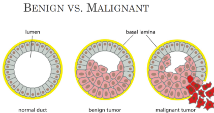 <p><span><u>Metastasis </u>=&nbsp;when cells are malignant and invade (THIS IS CANCER)&nbsp;</span></p><ul><li><p class="Paragraph SCXW230009754 BCX0" style="text-align: left"><span>Spread to more distant sites in the body to form secondary tumors&nbsp;</span></p></li></ul><ul><li><p class="Paragraph SCXW230009754 BCX0" style="text-align: left"><span>Fewer than 1 in 1000 cells will survive and metastasis successfully&nbsp;</span></p></li></ul><p></p>