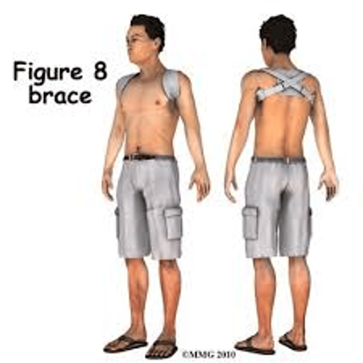 <p>- 80% of clavicle fractures occur in middle</p><p>- figure 8 brace vs surgery</p>