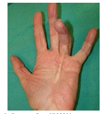 <p><strong>Progressive contracture of flexor tendons → flx deformity</strong></p><p><u>Clinical Presentation:</u> <strong>4th digit + isolated muscles</strong>, painful nodules/cords, limited extension ROM, blanching of the palm</p><p><u>Diagnosis:</u><strong> POP flexor tendon</strong>s, AROM/PROM, <strong>Heuston’s tabletop test</strong>, imaging, radiograph</p><p><u>Management</u>: Conservative, splint, injection, surgery, ROM, strength/control</p><p><u>Risk factors:</u> <strong>genetic </strong>disorders (diabetes, seizures, smoking, alcoholism, HIV, vascular disease), males</p>