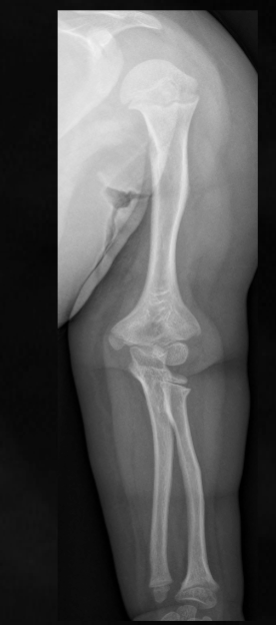 <p>what is seen here for this case of achondroplasia?</p>