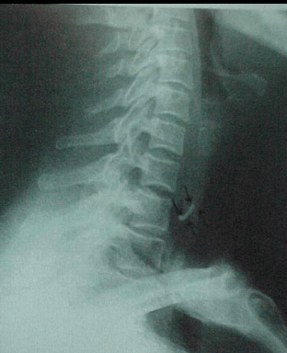 <p>- Dentures</p><p>- Food bones e.g. fish bones, chicken wings</p><p>- Children ingesting toys, batteries, etc.</p>