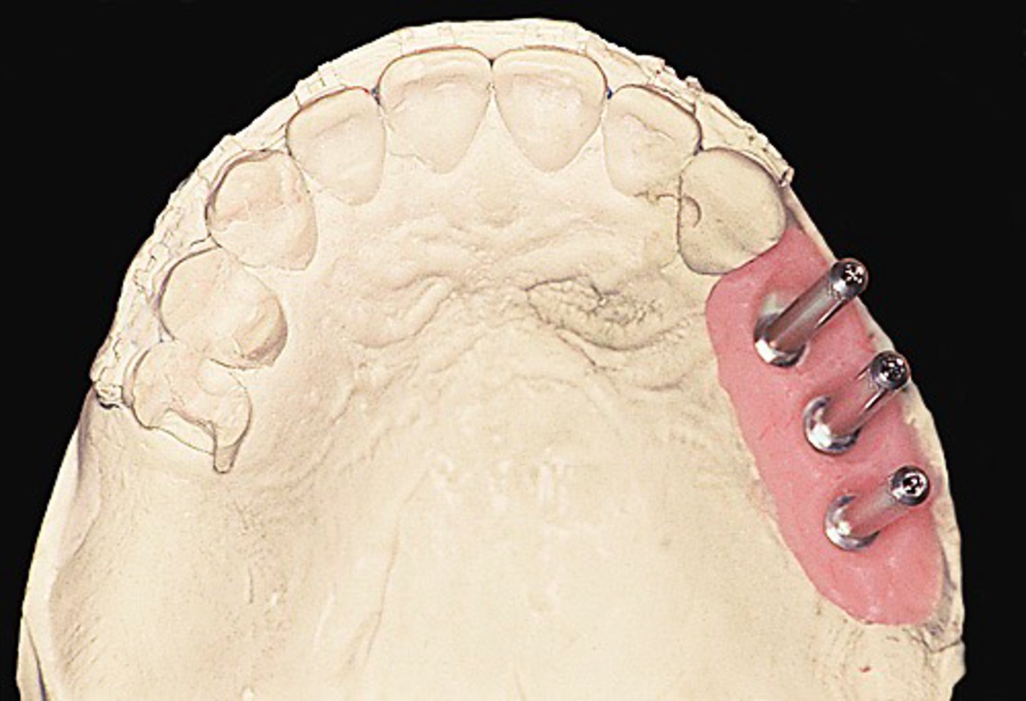 <p>-Type of laboratory screw used in the</p><p>fabrication of a prosthetic restoration.</p><p>• Surgical or restorative adjunctive marker used</p><p>to indicate implant angulation or location when</p><p>preparing osteotomy sites.</p>