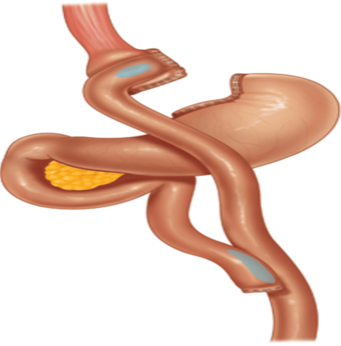 <p>Small pouch created from stomach</p><p>Part of small intestine bypassed</p><p>Restriction and malabsorption</p>