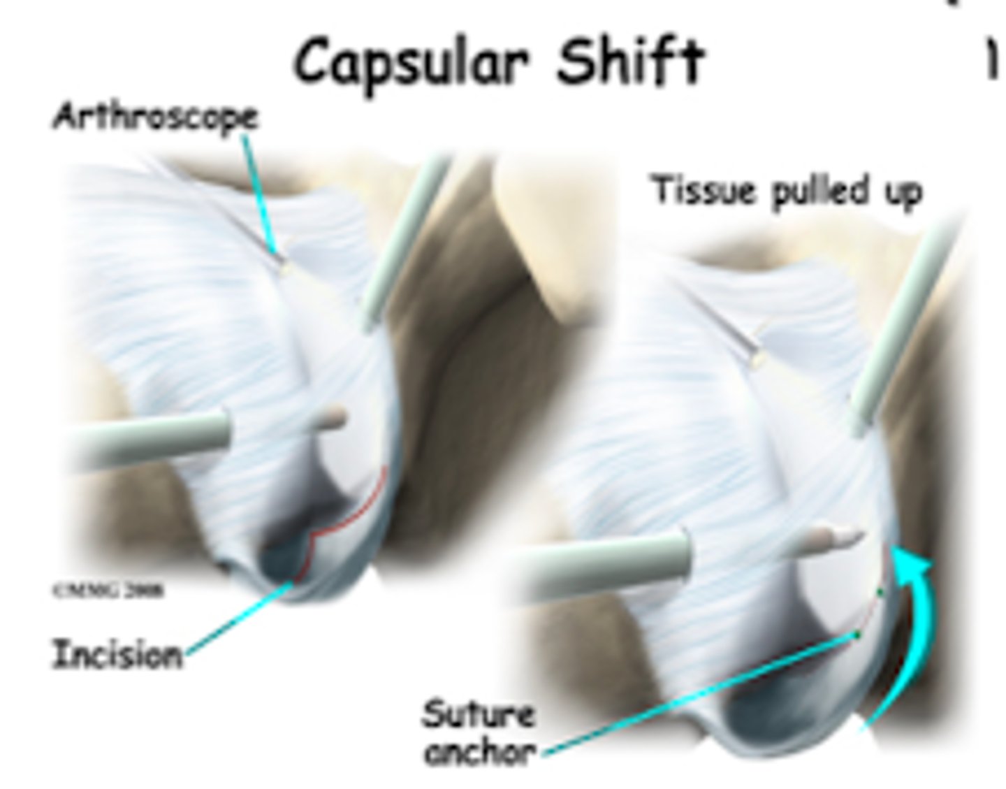 <p>capsular shift</p>