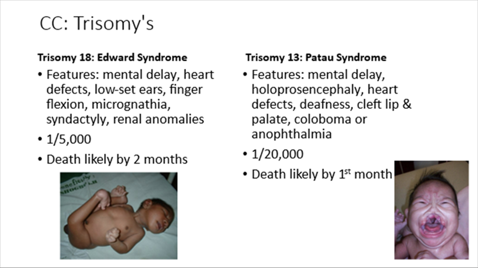 <p>Patau syndrome</p><p>Mental delay, holoprosencephaly, cleft lip/palate</p><p>Death likely by 1 month</p>