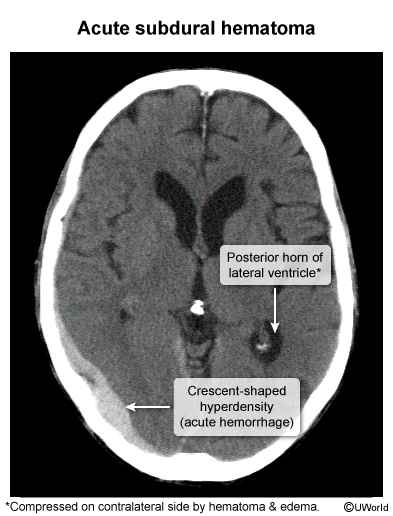 <p>acute subdural hematoma caused by tearing of the bridging veins</p>