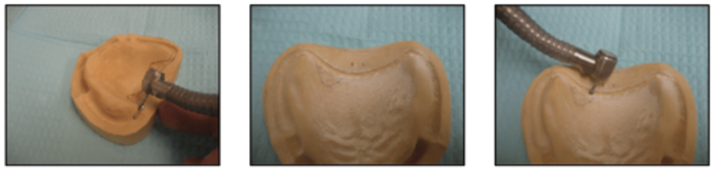 <p>Using a #8 round bur in the high speed hand-piece, create a channel at the posterior line of the post dam outline.</p><p>How deep should this channel be?</p>