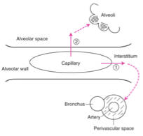 <ol><li><p>Le liquide commence à s’accumuler dans l’interstitiel (espace autour des vaisseaux)</p></li><li><p>Si l’accumulation continue, le liquide atteint les alvéoles</p></li><li><p>L’inondation des alvéoles gêne les échanges gazeux, provoquant une détresse respiratoire. </p></li></ol><p></p>