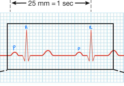 <p>time between two R waves and two P waves</p>