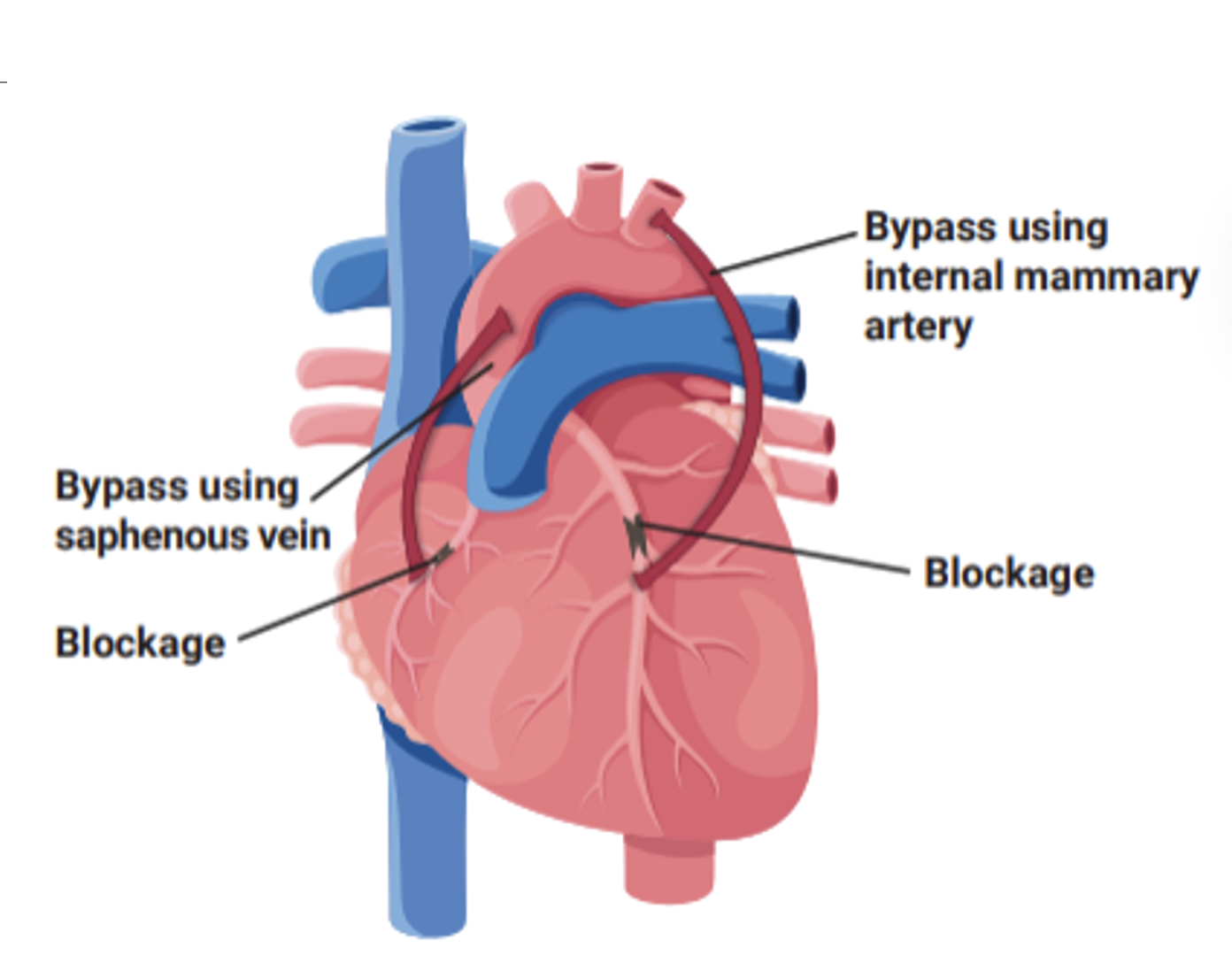<p>Myocardial infarction - Interventions: Reperfusion therapy</p>