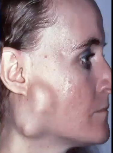 <p>Where might you find pleomorphic adenoma?</p>