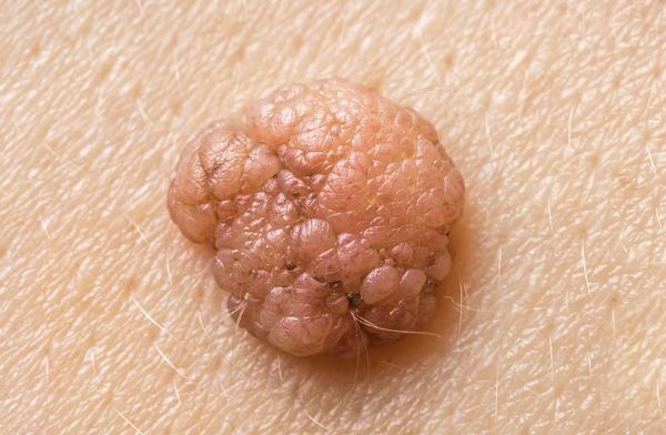 <p>what type of raised, primary skin lesion is this?</p>