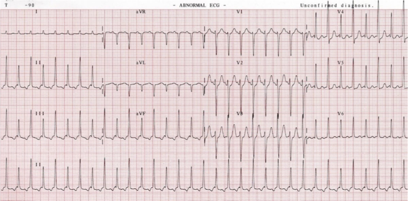 <p>What does this refer to “narrow QRS, rapid rhythm”</p>