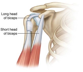 <p>The biceps tendon lives in the intertubercular groove and subluxation is when it comes out the groove (the picture is how it SHOULD be)</p>