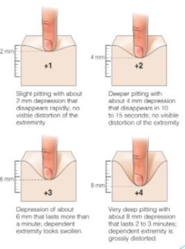 <p>Pitting edema</p>