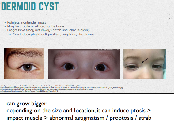 <ul><li><p>Congenital Charistoma of the orbit: benign tumor containing normal cells (i.e hair follicles, sweat glands, sebaceous glands), but in an abnormal location</p></li><li><p>Most common non-inflammatory orbital tumors in children</p></li><li><p>Commonly found at the frontozygomatic suture</p></li><li><p>Hard at the push; likely there since birth OR started growing at a few months</p></li><li><p>40% are Dx’d at birth</p></li><li><p>Desciption: Painless, nontender mass; may be mobile, or affixed to bone; progressive (can induce ptosis, astigmatism, proptosis, strabismus)</p></li><li><p>Refer to OMD asap to prevent spontaneous rupture &gt; infection</p></li><li><p>Early remove - smaller incision spot</p></li><li><p>If they alr have induced astig., it doesn’t go away post-Sx so we keep watching for amblyo. risk</p></li></ul><p></p>