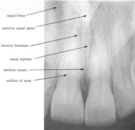 <p><span>separates the two nasal fossae</span></p><p><span>is seen as a </span><span style="color: red;"><span>radiopaque white line</span></span></p>