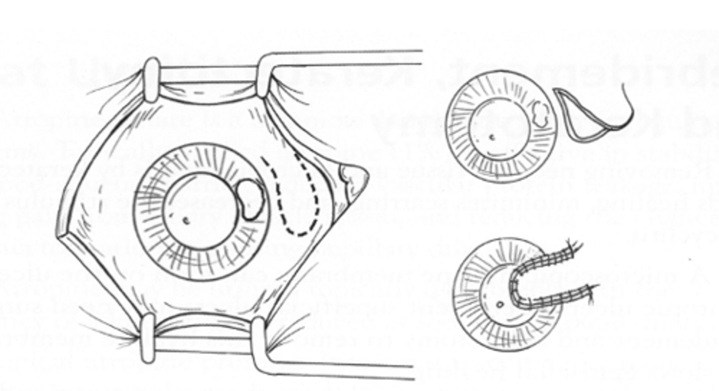 <p>1) Lift the bulbar conjunctiva off the globe and incise ~1 mm behind the limbus, and continue parallel to the limbus. Then make an incision perpendicular to this, and then another parallel to the first incision (create three sides of a rectangle running parallel to the limbus)</p><p>2) Undermine the conjunctival flap created in step 1</p><p>3) Rotate the graft over the corneal defect and suture it to the cornea (simple interrupted sutures)</p>