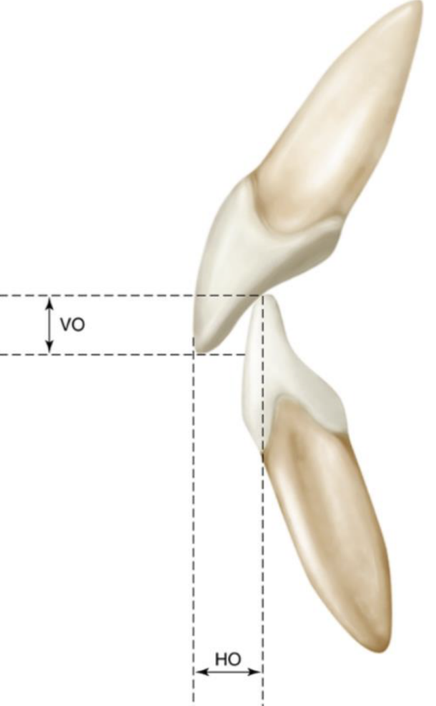 <p>horizontal distance by which max anteriors overlap mandib anteriors</p>