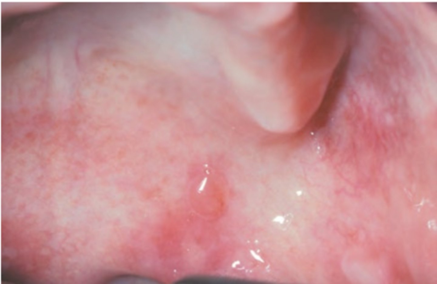 <p>Hint: in tact bullae</p>