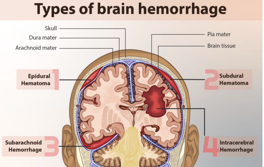 <p>Types of brain hemorrhage </p>