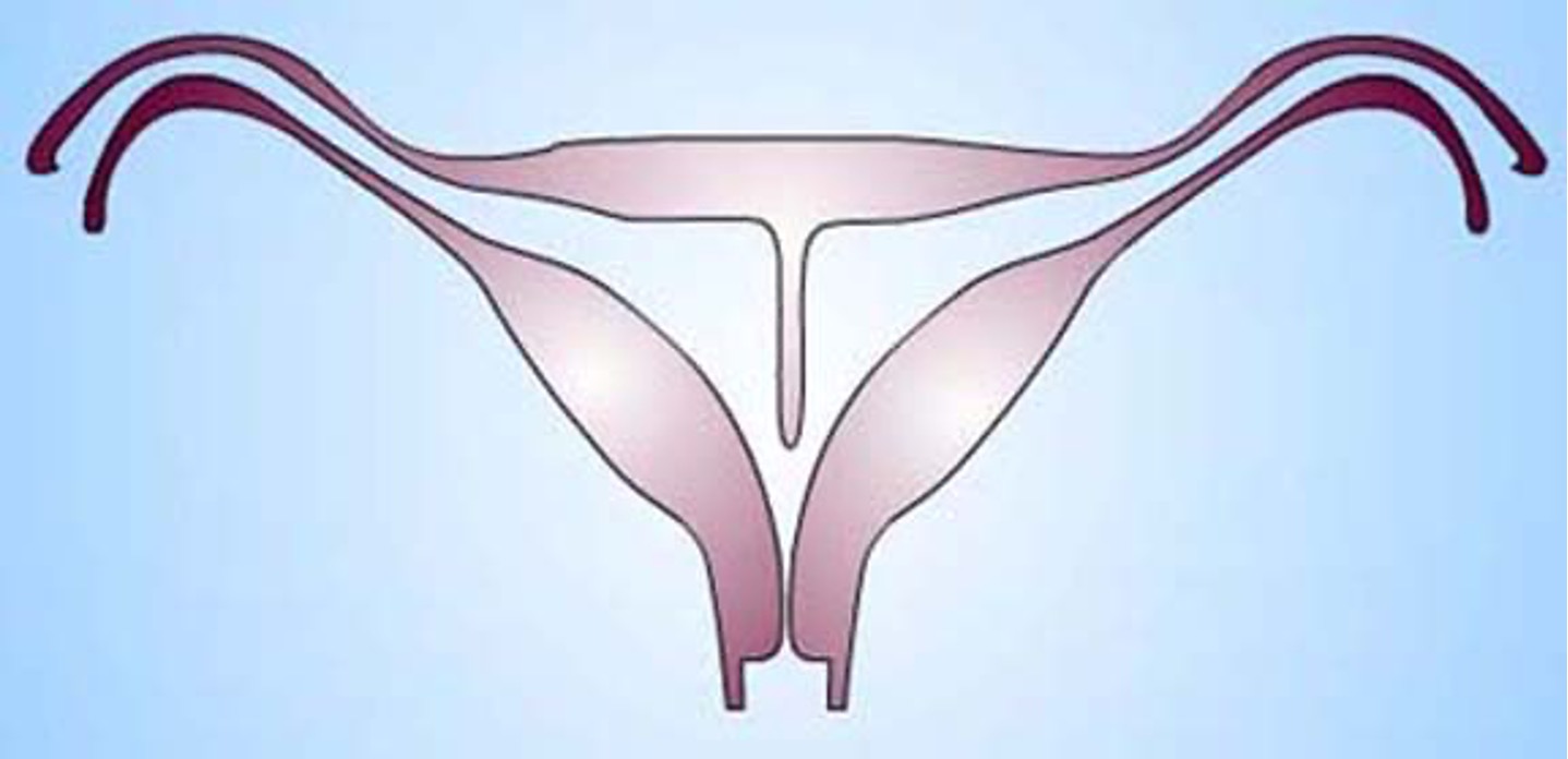 <p>What class mullerian defect?</p><ul><li><p><strong>septate uterus</strong> → results from failure of resorption of septum b/t 2 uterine horns</p></li><li><p>septum can be partial or complete</p></li><li><p>uterine fundus is typically convex but may be flat or slightly concave</p></li><li><p>highest incidence of reproductive complications</p></li><li><p>treated by using transvaginal hysteroscopic resection of septum</p></li></ul><p></p>