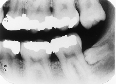 <p>What term(s) best describe(s) the most distal mandibular tooth?</p><p> </p><p>supernumerary</p><p> </p><p>microdont</p><p> </p><p>cute</p><p> </p><p>all of the above</p>