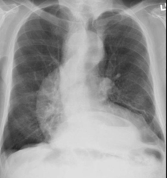 <ul><li><p>large HH can show on CXR as a mass behind the mediastinum </p></li></ul><p></p>