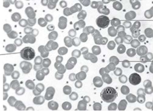<p>X is a lymphocyte</p><p>Y is a neutrophil </p>