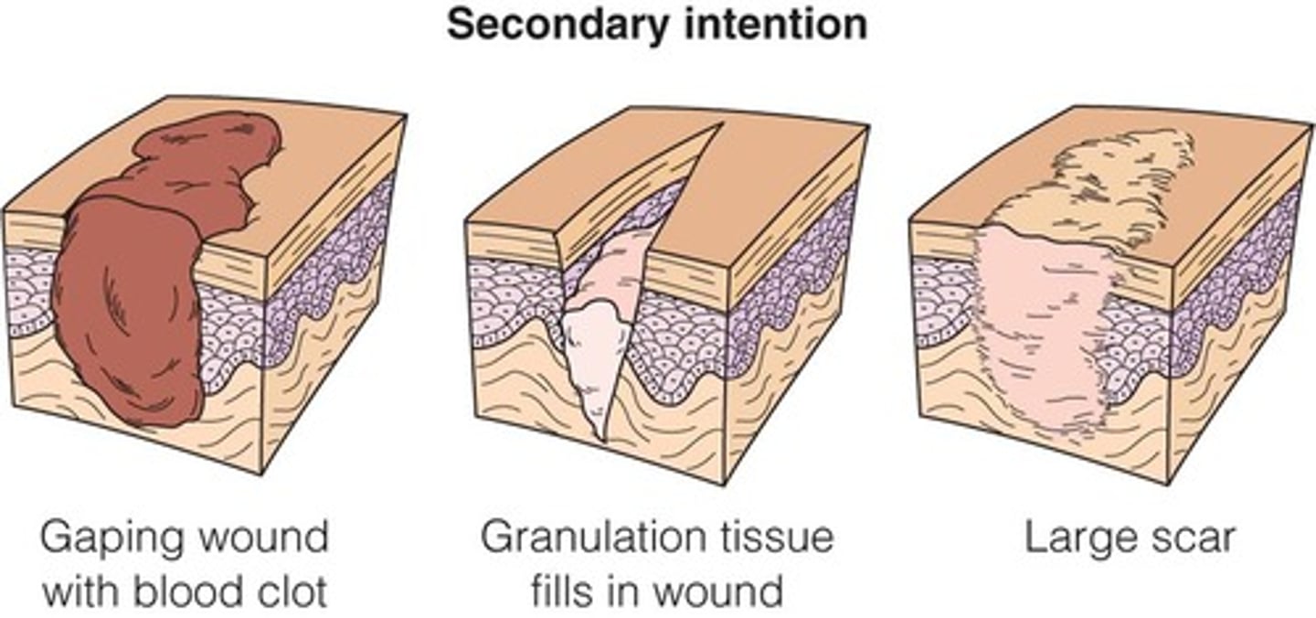 <p>Wound margins are not well approximated; larger wound area requires the formation of granulation tissue to fill in the gap. A longer period of time is needed to heal.</p>