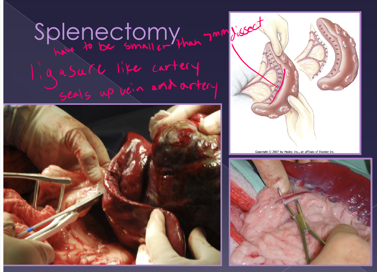 <ul><li><p>preferred method </p></li><li><p>indications </p><ul><li><p>neoplasia </p></li><li><p>severe trauma </p></li><li><p>immune-mediated disease </p></li></ul></li><li><p>concern </p><ul><li><p>large-volume blood loss </p></li></ul></li><li><p>classic approach </p><ul><li><p>exteriorize and isolate spleen </p></li><li><p>dissect, ligate, and divide all <strong>hilar vessels </strong></p><ul><li><p>do not damage the short gastric aa. </p></li><li><p>time consuming </p></li><li><p>more option for hemorrhage </p></li></ul></li></ul></li><li><p>alternate approach </p><ul><li><p>abdominal exploration </p></li><li><p>exteriorize and isolate the spleen </p></li><li><p>identify the splenic artery and vein distal to: </p><ul><li><p>pancreatic branch </p></li><li><p>short gastric aa </p></li><li><p>left gastroepiploic a </p></li></ul></li><li><p>quicker </p></li><li><p>ok for normal spleen with no adhesions </p></li></ul></li></ul><p></p>