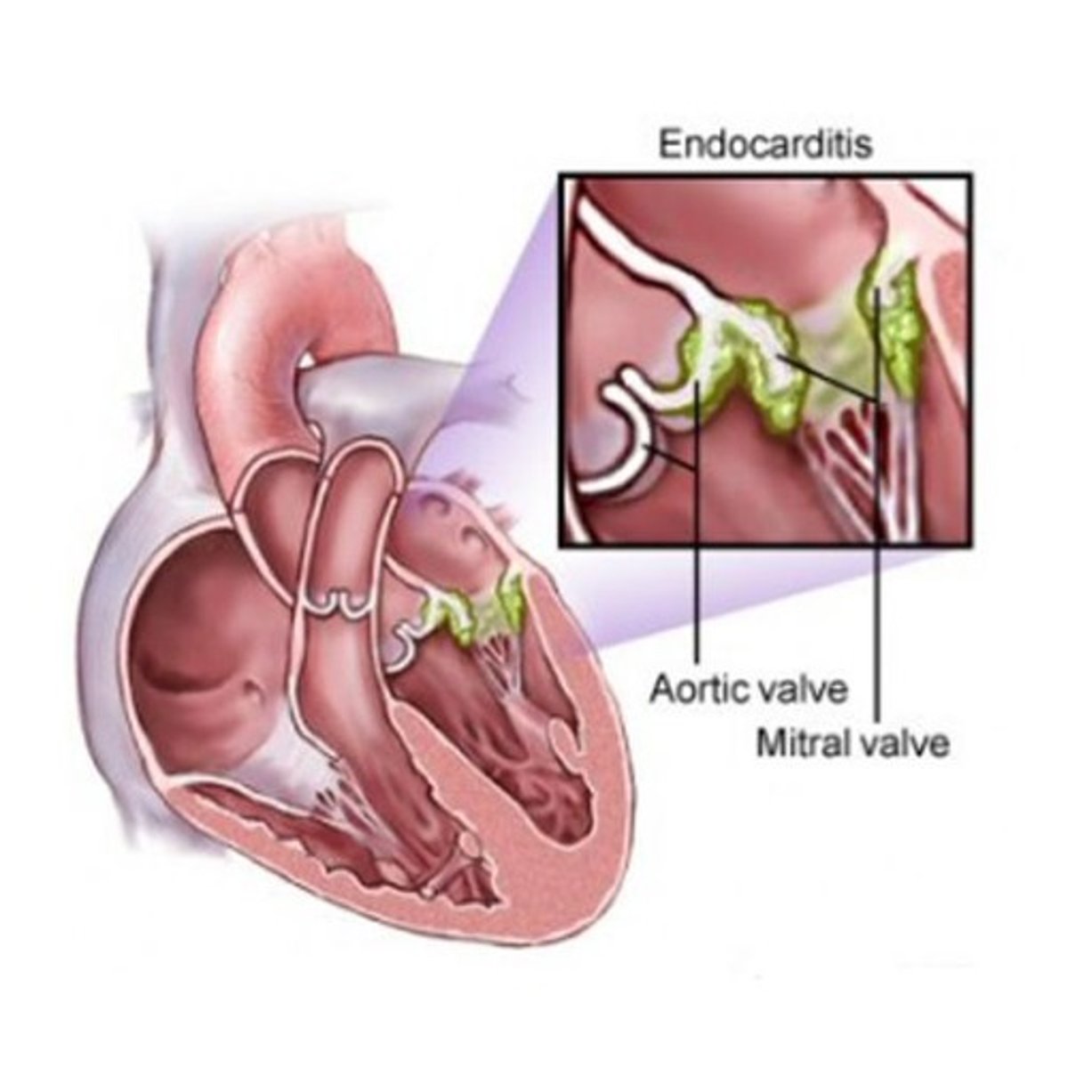 <p>(viêm nội tâm mạc)______ is a chronic condition in which the inner layers of the heart become inflamed due to bacteria growing inside.</p>
