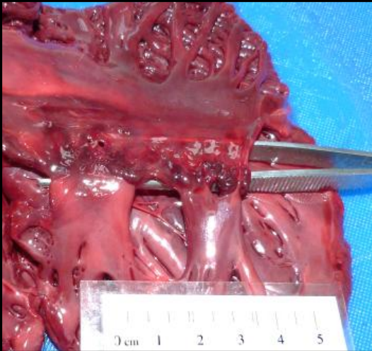 <p>If you diagnosed AV dysplasia in a live puppy, is there a significant concern that the dysplastic tissue is at increased risk of transformation into neoplastic tissue?</p>