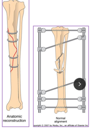 <p>Fracture Forces</p>