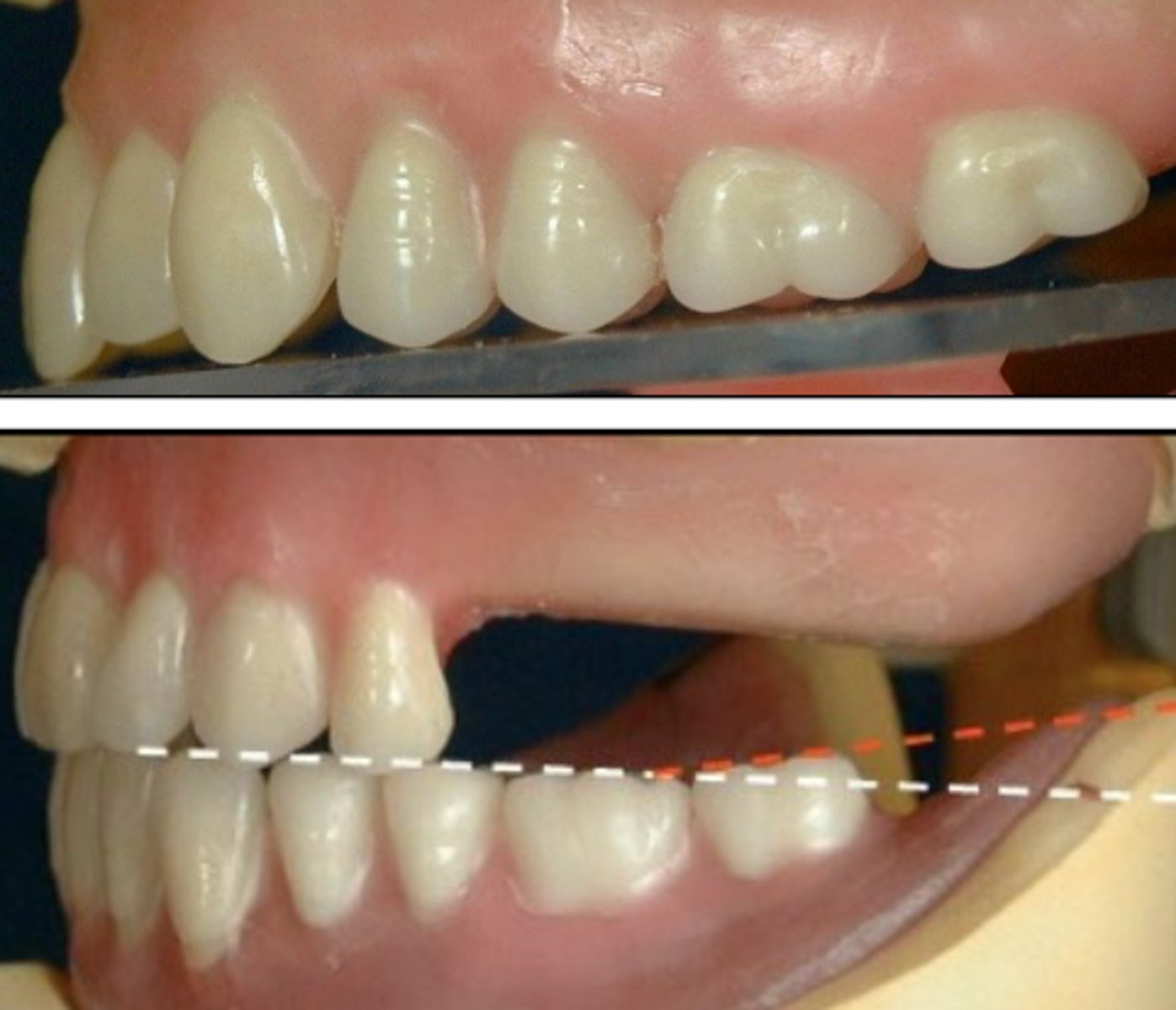 <p>To create the curve/ramp, the second mandibular molar is elevated how much?</p>