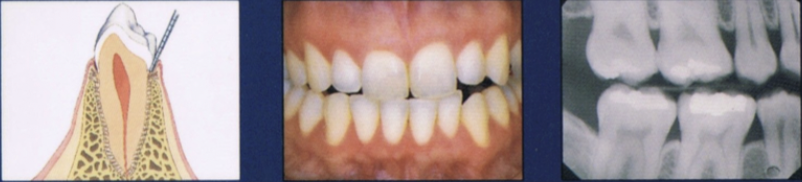 <ul><li><p>Firm and resilient tissue, minimal sulcus depth</p></li><li><p>Coral pink</p></li><li><p>Variations in color may depend on race</p></li><li><p>Evidence of previous disease may be present</p></li></ul><p></p>