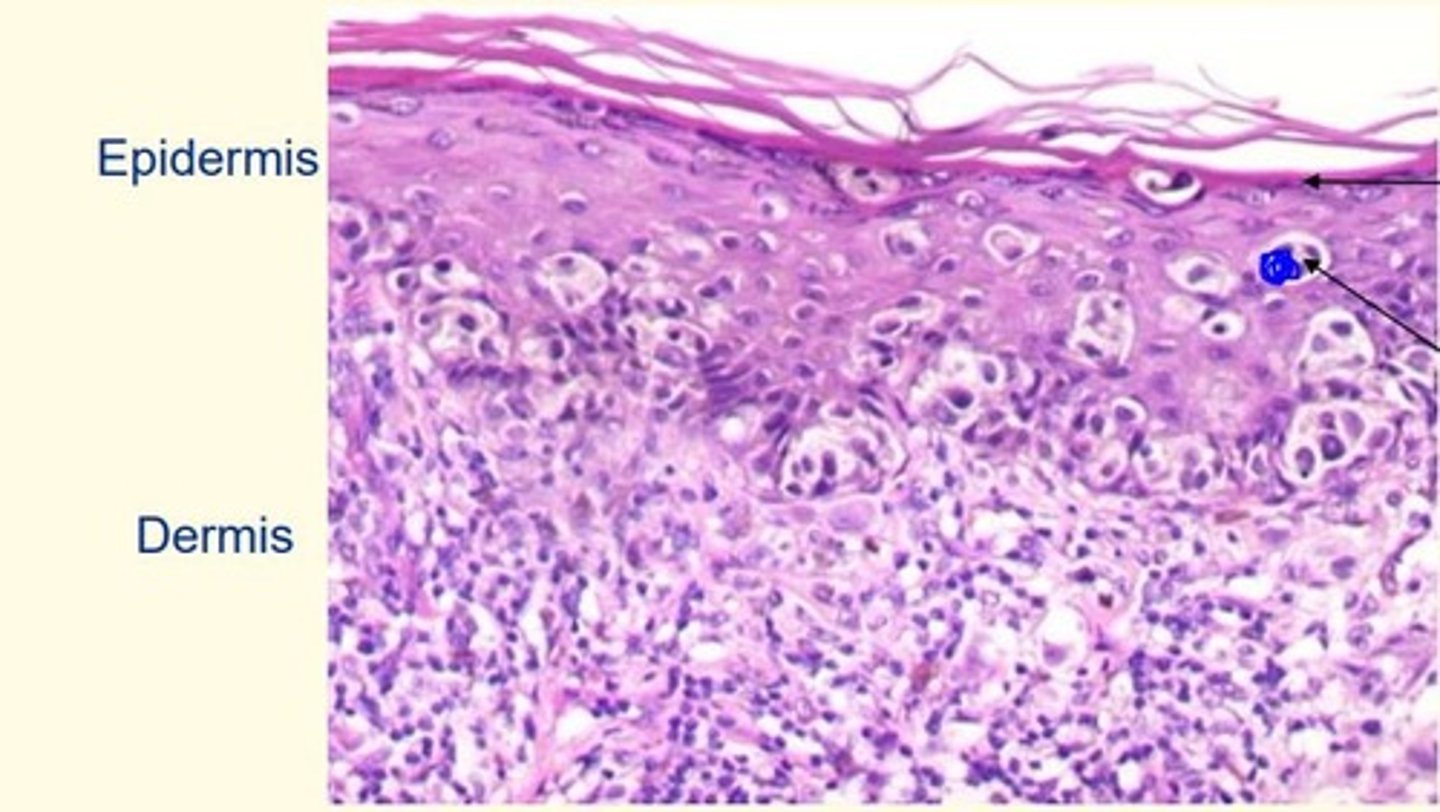 <p>Dividing melanocytes </p><p>The top layer is the = granular layer (last living layer of the epidermis)</p>