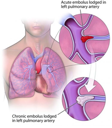 <p>What does this refer to </p><ul><li><p>Persistent obstruction after PE</p></li><li><p>Fibrotic webs and bands in arteries</p></li><li><p>Secondary arteriopathy develops over time</p></li></ul><p></p>