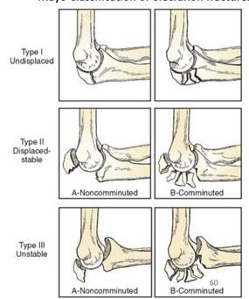 <p>FOOSH or direct trauma.</p>