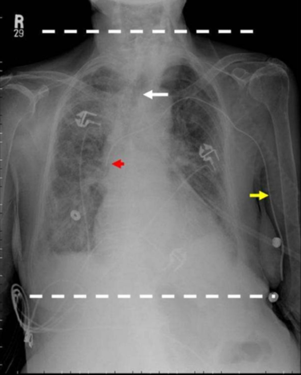 <p>Clinical Implications of Peripherally Inserted Central Catheter (PICC):</p><p>- Repeated _______________________ at the joints of catheter insertion should be limited and/or contraindicated to prevent dislodgement and venous damage.</p><p>- If dislodged, apply immediate ______________________ and call for assistance.</p><p>- Avoid using _________________________ → Use walker</p><p>- May need _______________________ confirmation after placement.</p>