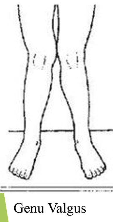 <p>Knock-kneed</p><ul><li><p>Femoral shaft > 10º from vertical. </p></li><li><p>Increased weight bearing on the lateral femoral condyle and lateral tibial plateau– sites for DJD. </p></li></ul><p></p>