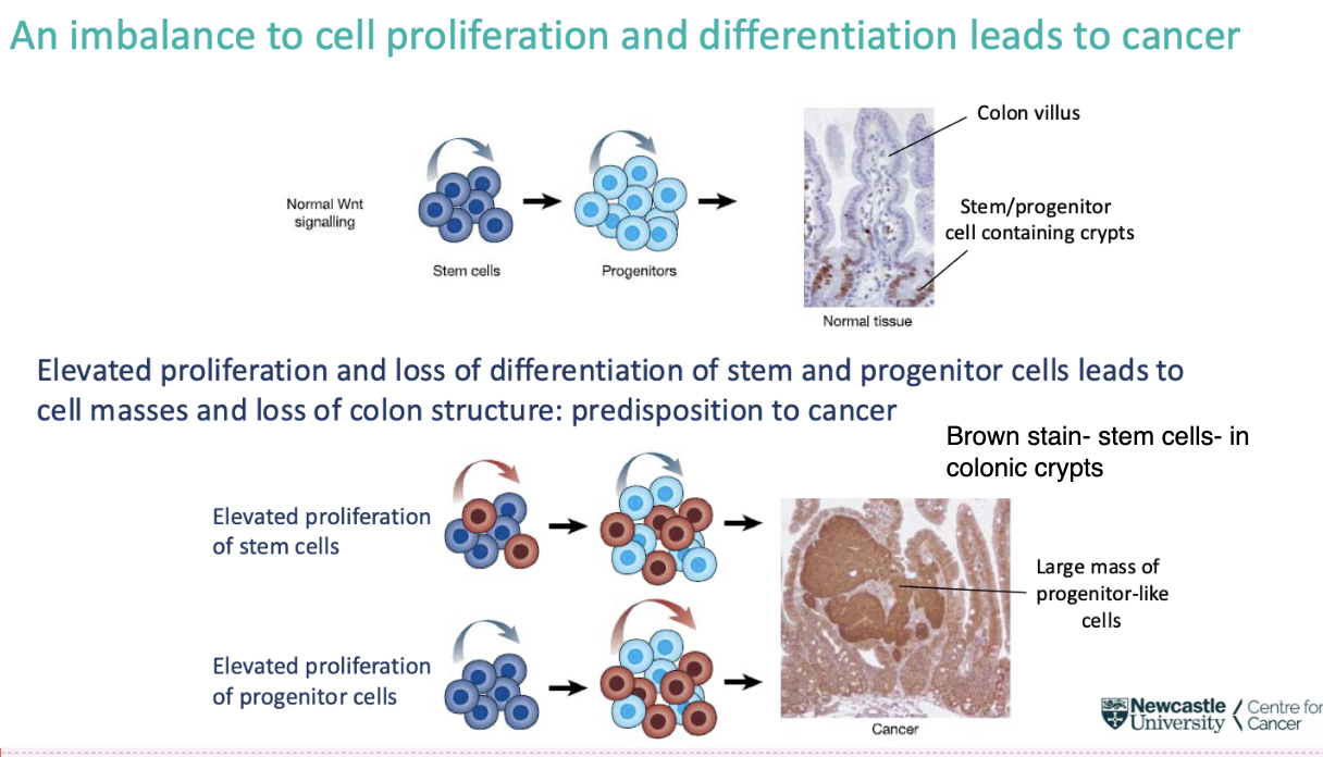 <p>cancer</p><p><span style="background-color: inherit; line-height: 22px; color: windowtext;"><span>In colon cancer- deregulated stem cell renewal capacity</span></span><span style="line-height: 22px; color: windowtext;"><span> cell masses and loss of colon structure- predisposition to cancer</span></span></p><ul><li><p class="Paragraph SCXO42306489 BCX0" style="text-align: left;"><span style="background-color: inherit; line-height: 22px; color: windowtext;"><span>Outgrowth of poorly differentiated cells, crypts erupt into masses, lose functionality of colon</span></span><span style="line-height: 22px; color: windowtext;"><span>&nbsp;</span></span></p></li><li><p class="Paragraph SCXO42306489 BCX0" style="text-align: left;"><span style="background-color: inherit; line-height: 22px; color: windowtext;"><span>Example of imbalance of homeostasis of stem and progenitor cell differentiation</span></span><span style="line-height: 22px; color: windowtext;"><span>&nbsp;</span></span></p></li></ul><p></p>