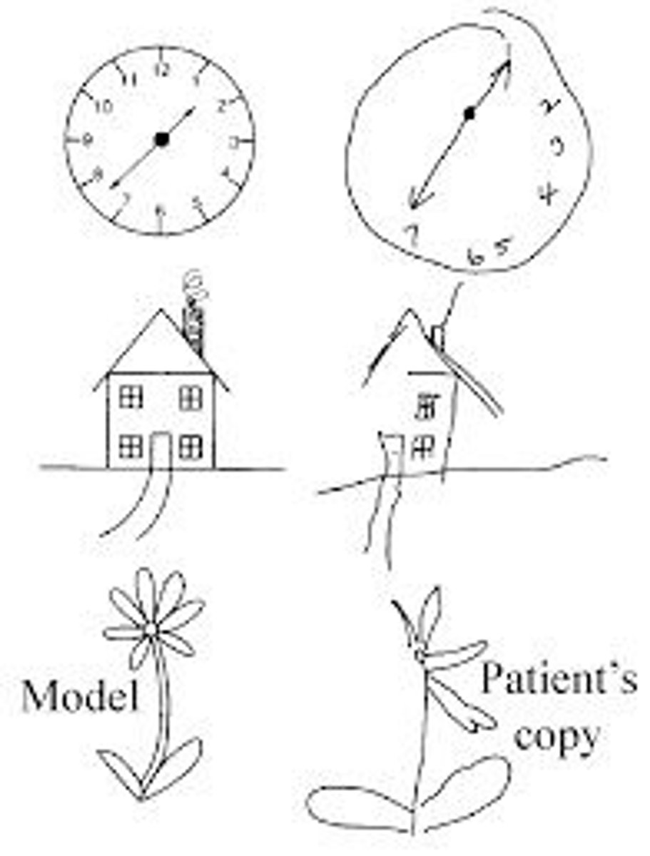 <p>Patient may have distortions of the perception on the contralateral side. If drawn a clock, the numbers would be filled all on one side</p>