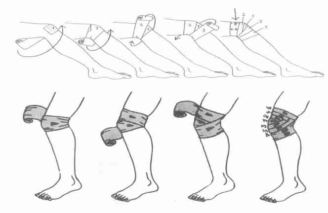 <ul><li><p>houd lidmaat in lichte flexie</p></li><li><p>2 cirkelslagen van knie naar knieplooi</p></li><li><p>vervolgens cirkelslag naar proximaal, vervolgens distaal, divergerend op strekzijde & convergerend op plooizijde</p></li><li><p>elke omwinding bedekt met deels de vorige</p></li><li><p>fixeren: kleefpleister</p></li></ul>