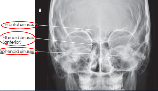<ul><li><p>demonstrates:</p><ul><li><p>frontal sinuses above frontonasal suture</p></li><li><p>anterior ethmoidal air cells</p></li><li><p>sphenoid sinuses seen through nasal fossa below or between ethmoids</p></li><li><p>petrous pyramodis lower third of orbits</p></li></ul></li><li><p>primarily demonstrates the frontal sinuses and anterior ethmoidal air cells</p></li><li><p>anterior ethmoidal air cells above petrous ridges</p></li><li><p>no rotation or tilt</p><ul><li><p>equidistant lateral borders of the skull and lateral borders of the orbits</p></li><li><p>symmetric petrous ridges</p></li><li><p>MSP of head aligned with long axis of collimated field</p></li></ul></li><li><p>air-fluid levels, if present</p></li></ul><p></p>