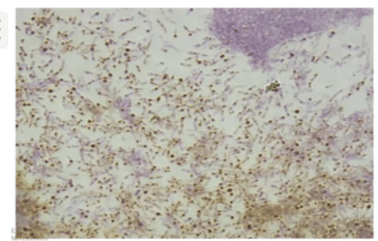 <p>- izmanto difterijas ierosinātājam corynebacterium diphteriae (gram+ nūjiņveida baktērija)</p><p>- var redzēt šūnas ieslēgumus - volutīna graudus (tie nav iekrāsoti)</p><p>- pacienta materiāls - iztriepe no pseidomembrānas malas (no rīkles nekrotiski audi) - kultivēšana - tīrkultūra, Neissera metode</p><p>- izmanto reti</p><p>- tiek izmantota vienkāršā metode ar metilēnzilo</p>