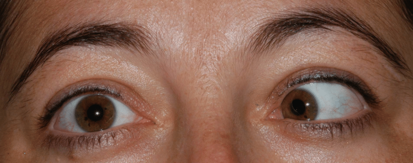 <p>Abducens (VI) Palsy</p>